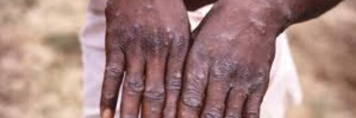 Opposition urges government to ensure Mpox isolation areas are secure