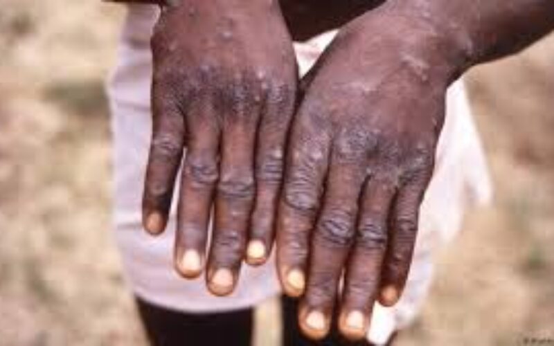 Opposition urges government to ensure Mpox isolation areas are secure