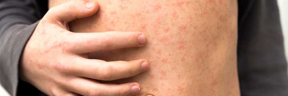 Health Ministry says there is no measles case in Jamaica