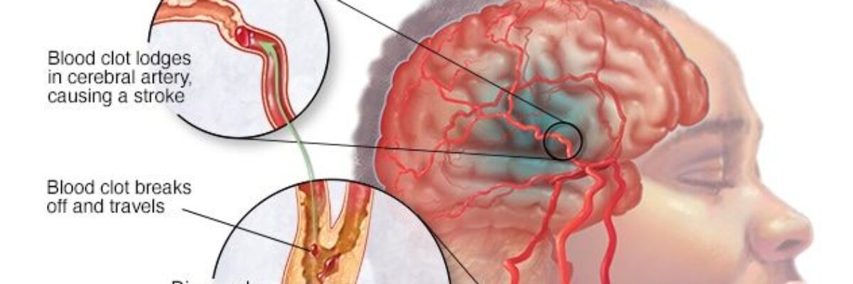 Health Ministry reports that over 7,000 people suffered a stroke last year