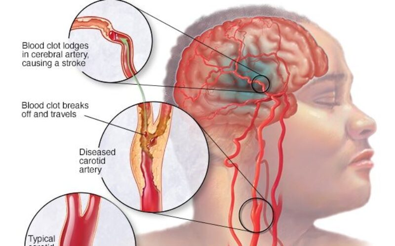 Health Ministry reports that over 7,000 people suffered a stroke last year